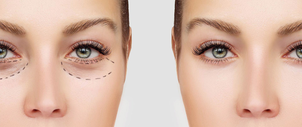 Before and after lower eyelid cosmetic surgery