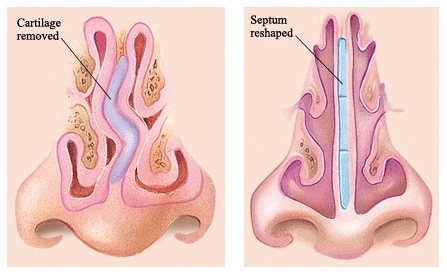 عمل جراحی سپتوپلاستی چیست